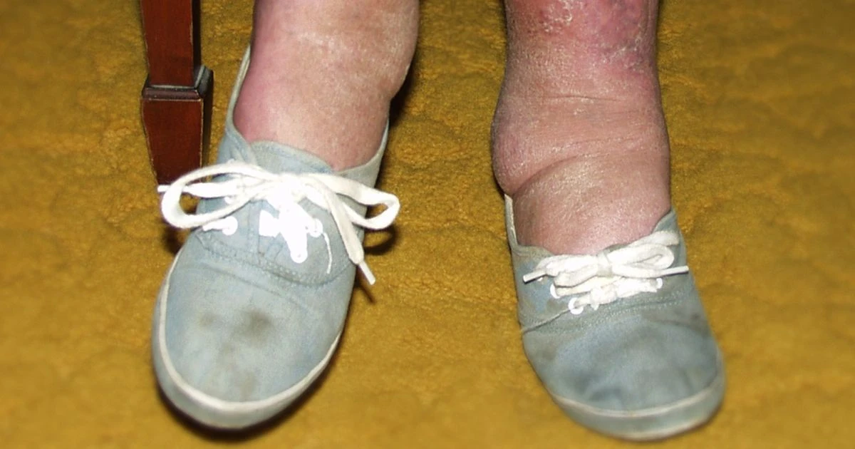 Heart disease risk factor determined by your socks and ankles – signs to spot