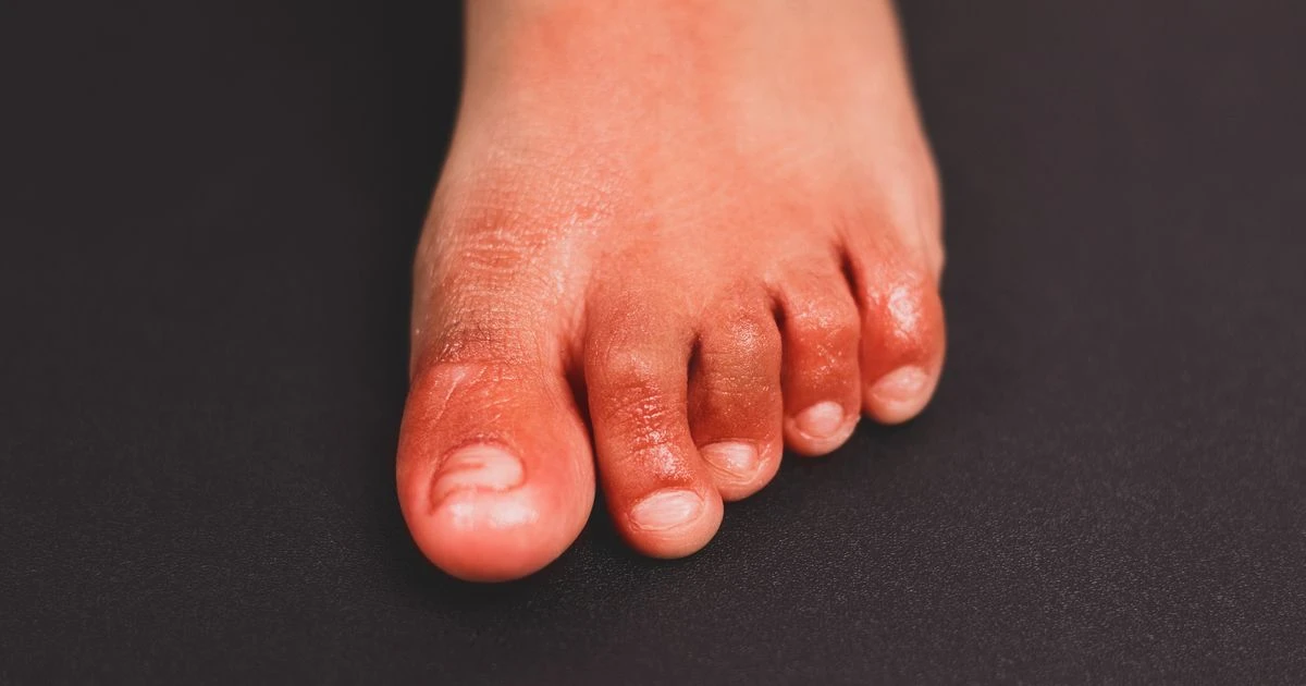 Coronavirus - every symptom you need to be aware of including 'Covid toes' and hiccups