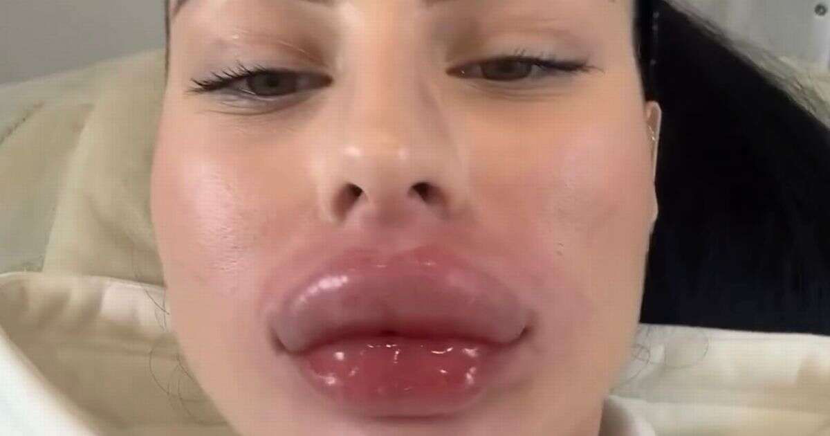 Influencer has severe allergic reaction to lip filler removal