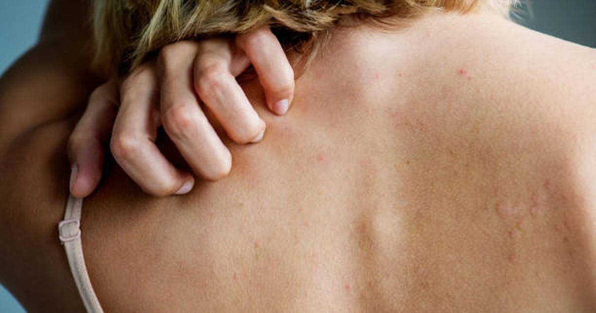 Bed bugs bites: All the signs you've been bitten - and the difference from other insectsBed bugs