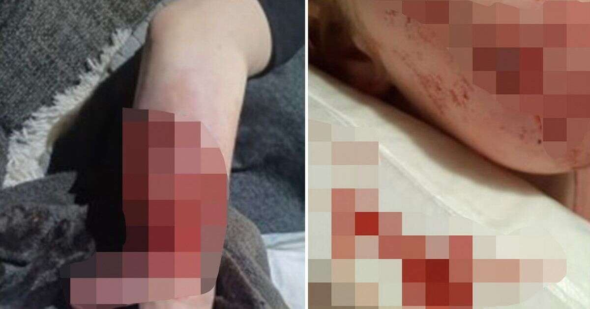 Horror dog attack injuries leaves teenage girl with skin peeled off her arm and needing surgery