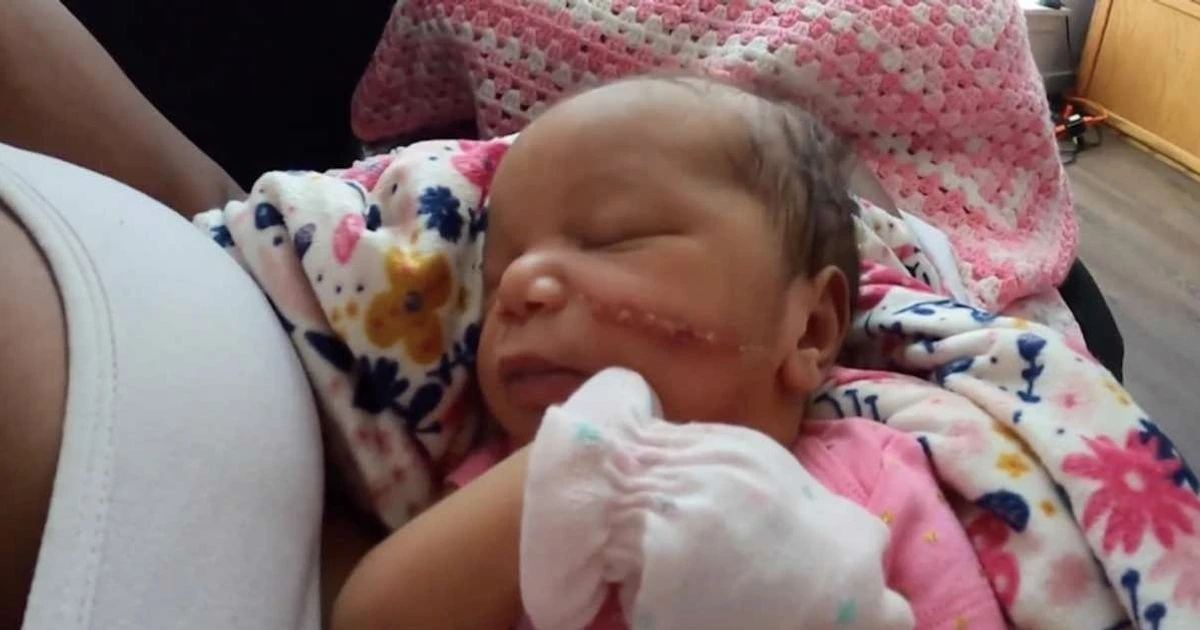 Newborn left needing 15 stitches on cheek after face was cut during C-section