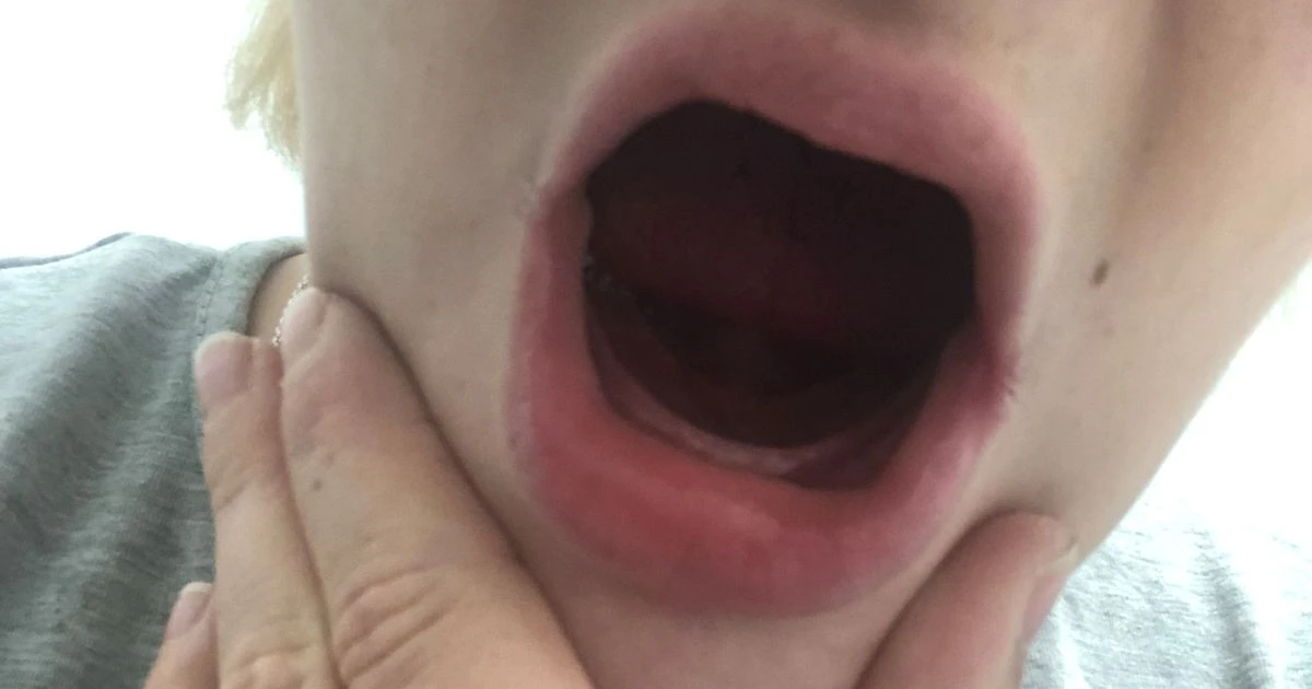 Mum, 24, has no teeth after losing them during horrific pregnancy sickness