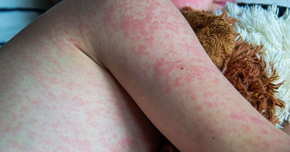 'Concerning' spike of highly infectious measles disease as experts issue plea to parents