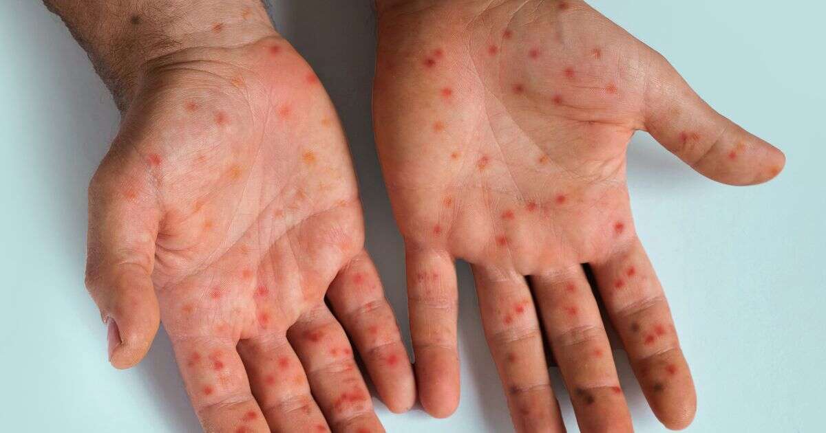 Mpox: Eighth case of new 'most dangerous yet' strain detected in the UK