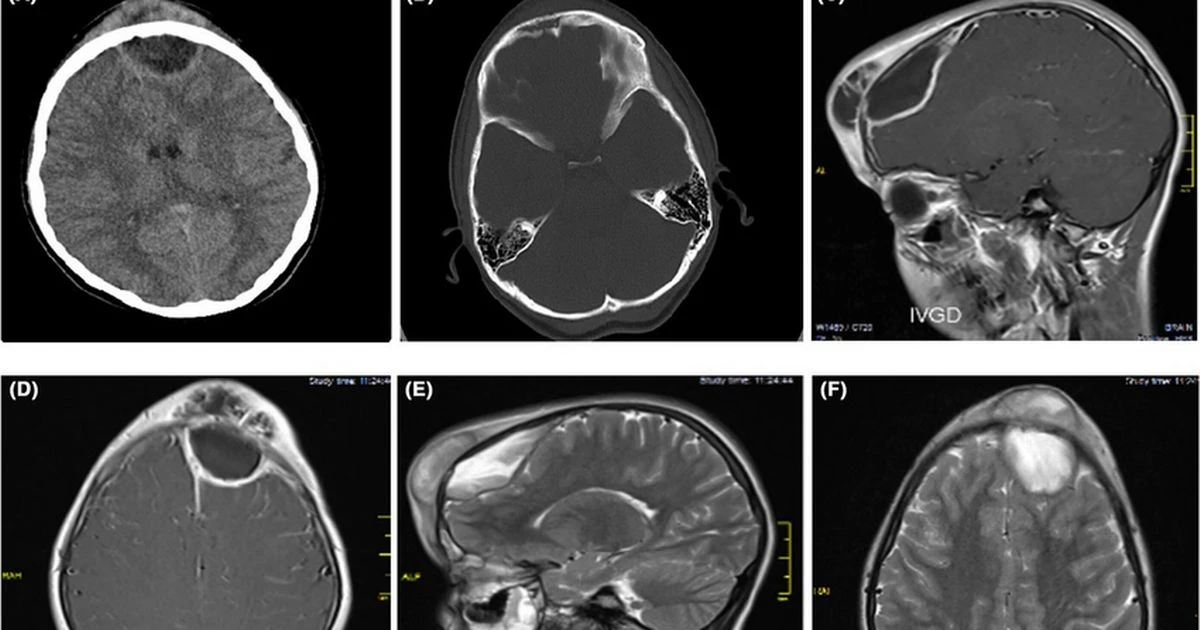 'Harmless pimple' on little girl's head grew into a life-threatening swelling