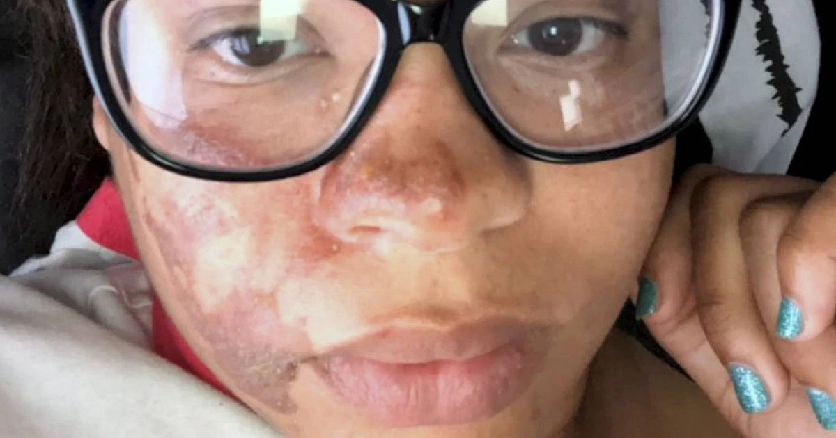 Mum suffered 'napalm-like' burns to face in Ladies Day piping hot pie attack