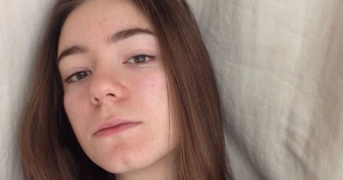 Student left with 'football-sized head' after painful allergic reaction to hair dye