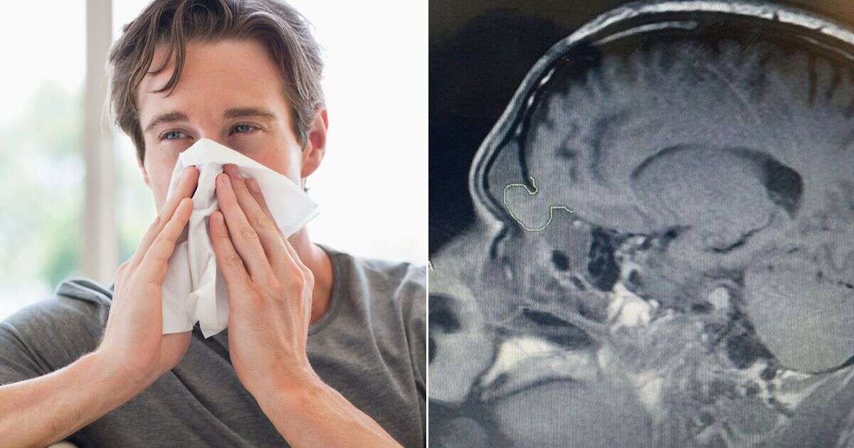 Man, 20, with a constant runny nose finds out his brain was poking out and 'leaking'