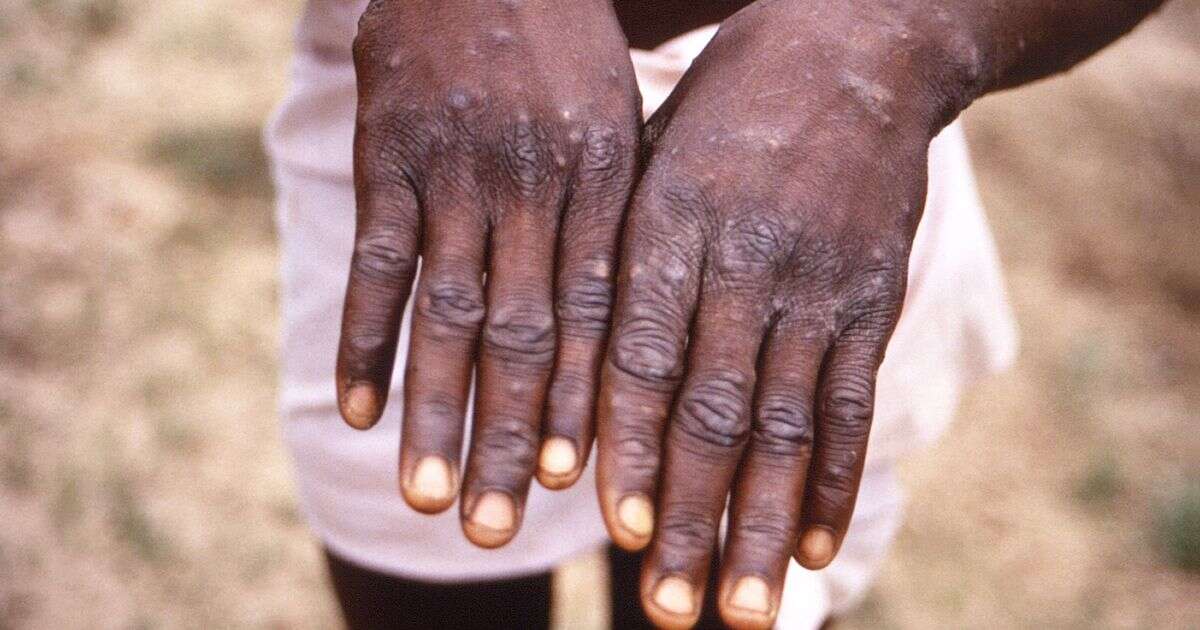 Mpox outbreak horror as new strain tears through mining town