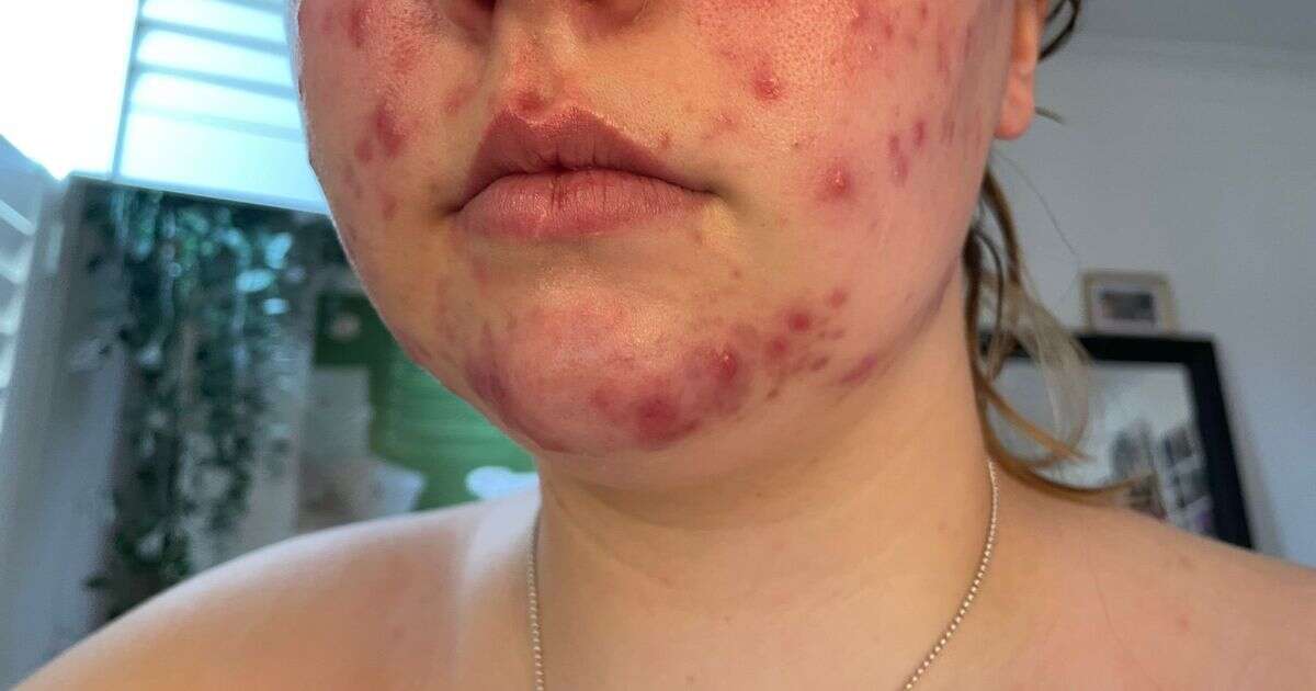 Woman with 'painful' acne says 'it’s just so many heightened emotions'