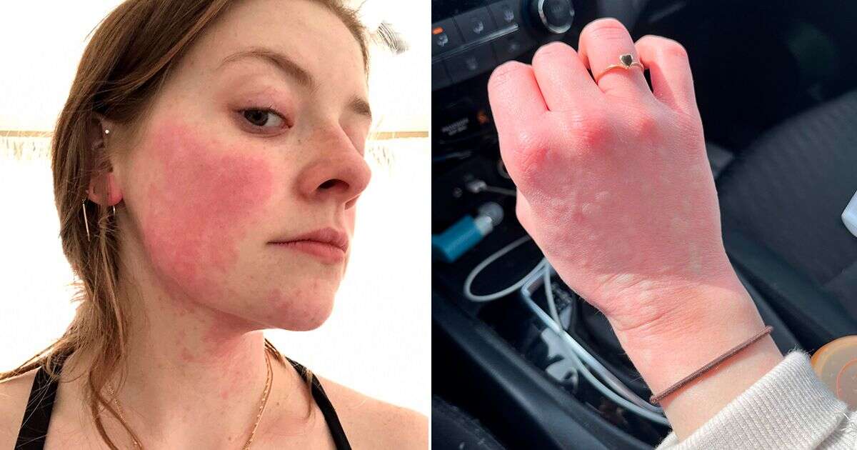 'I'm allergic to winter - five minutes outside in snow leaves me covered in blisters'