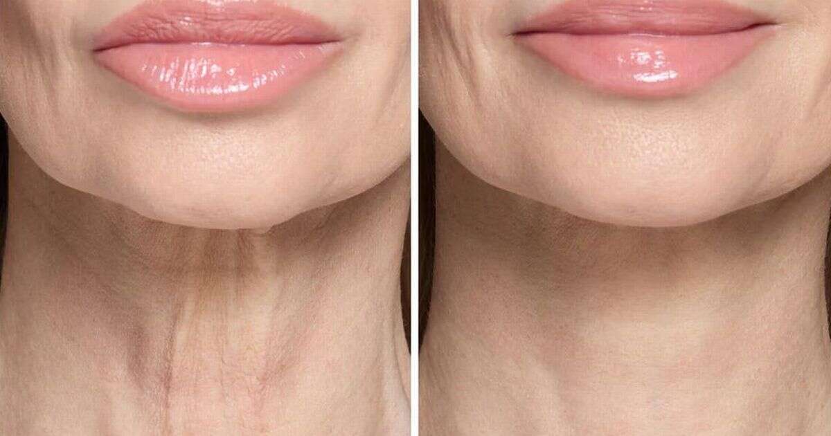 Beauty buffs rave about non-surgical instant fix for ‘turkey neck’ that makes an ‘amazing difference’