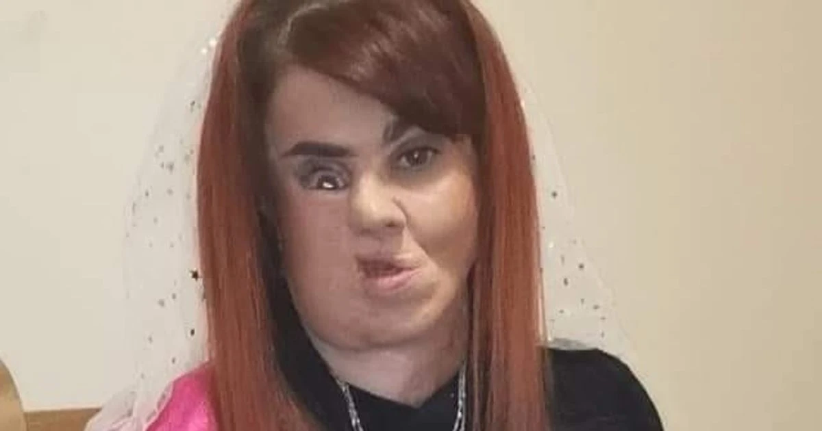 Woman who lost parts of face to flesh-eating bug left feeling like 'freak show'