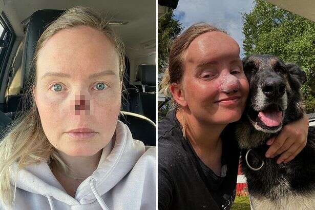 Woman who had nose bitten off by pet dog bred to hunt bears decides to keep it