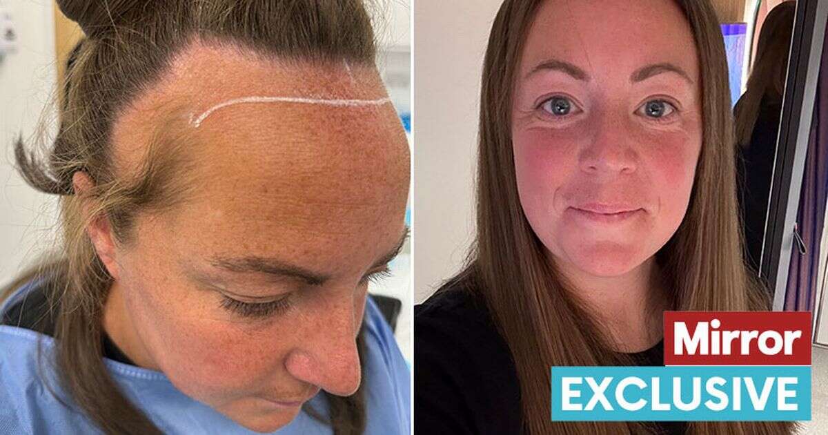 'I spent £6k on a hair transplant and have no regrets - women shouldn't be scared'