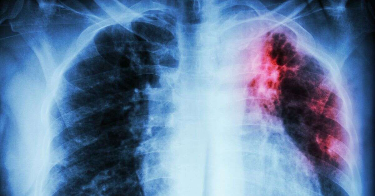 Victorian disease cases surge across England as health chiefs send urgent tuberculosis warning