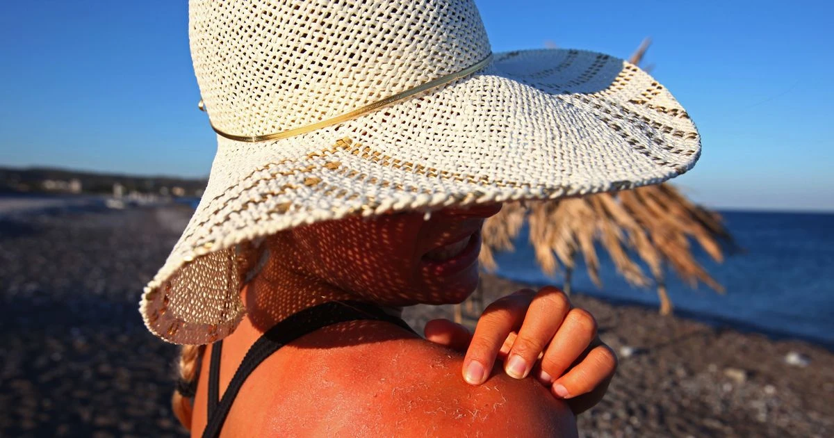 How to treat sunburn fast - and five things you should never do, according to NHS