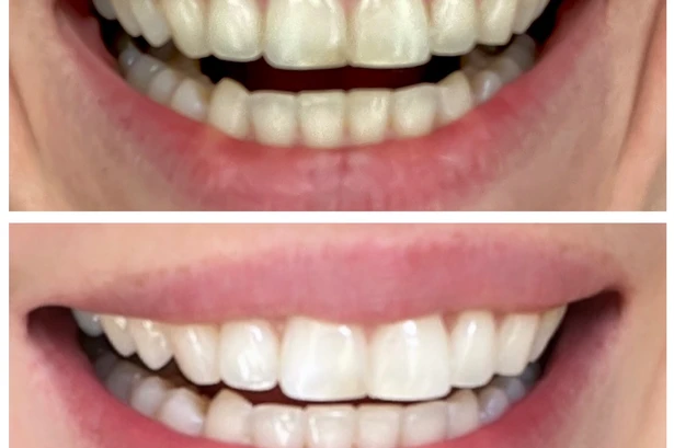 The £20 'dentist-approved' teeth whitening product that will fit into your holiday luggage