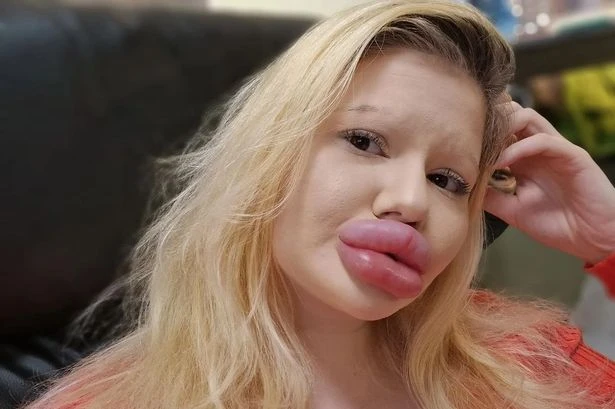 Woman with 'world's biggest lips' was natural beauty before extreme filler
