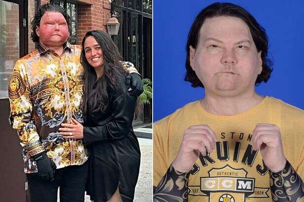 Man who had world's first face transplant shares engagement pics after horror blaze