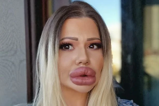 Woman with 'world's biggest lips' puts on red lipstick and the results are astonishing