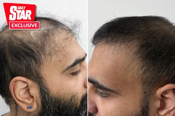 'I had a botched hair transplant 10 years ago but it didn't put me off trying again'