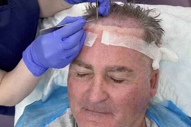 Ex-Sky Sports host Richard Keys shows off surprise effects of his hair transplant