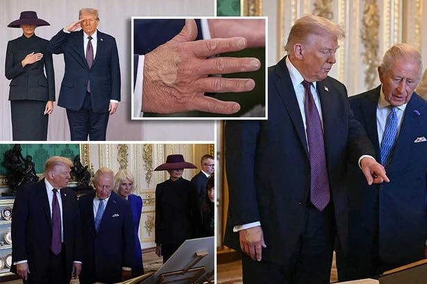 Donald Trump sparks new heath fears with mysterious white patch on hand during UK state visit
