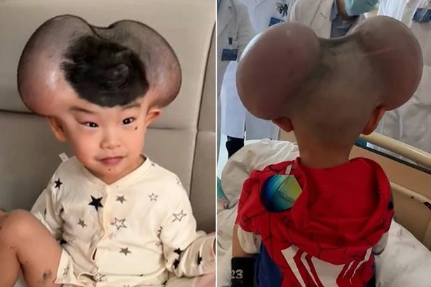 Boy cruelly nicknamed 'Mickey Mouse' over giant head growths has amazing transformation