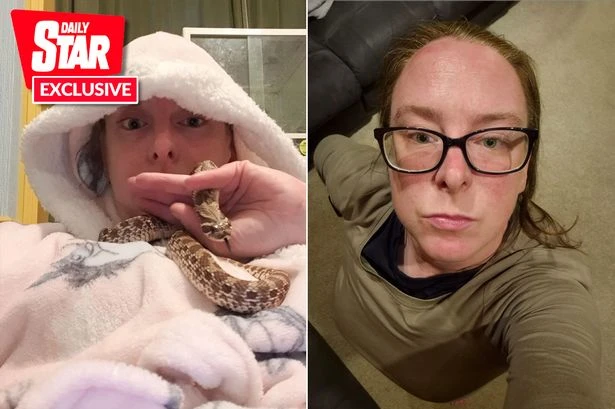 Carer in hospital when snake tried to eat her after mistaking her thumb for a mouse