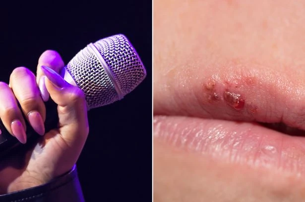 Woman says she caught herpes by holding karaoke mic too close to her mouth