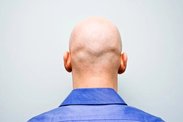 Balding blokes rejoice as salmon sperm injections set to 'boost' hair growth