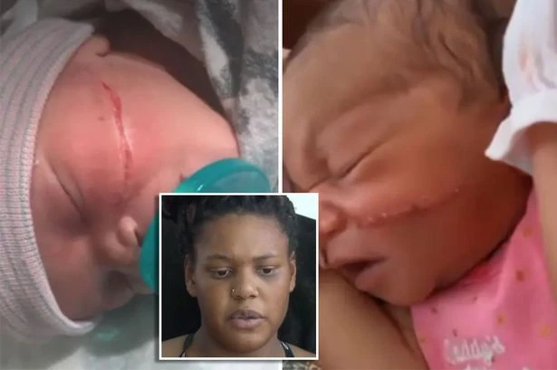 Newborn baby girl sliced across the face in 'rare' botched emergency caesarean delivery