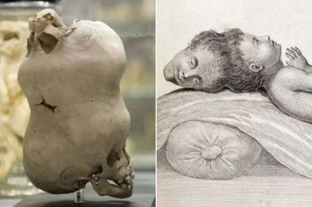 Boy born with two heads and one upside down was thrown on fire before bizarre death