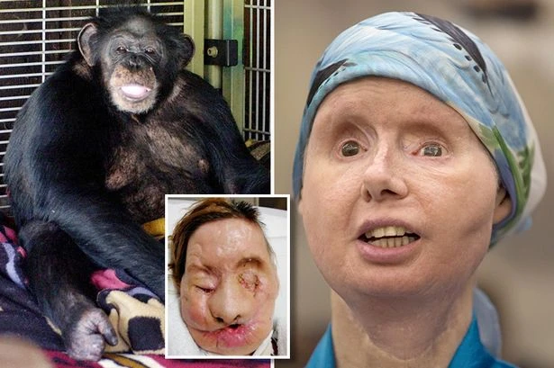 Woman's horror injuries as pet chimp rips off her face and hands and starts eating her eyes