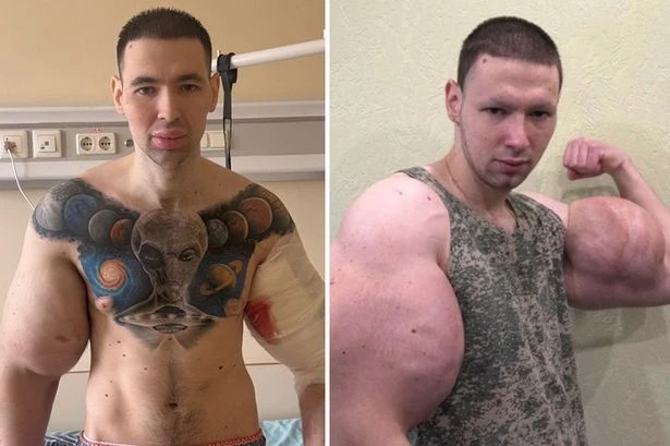 'Russian Popeye' who injected oil into biceps hospitalised after health fears