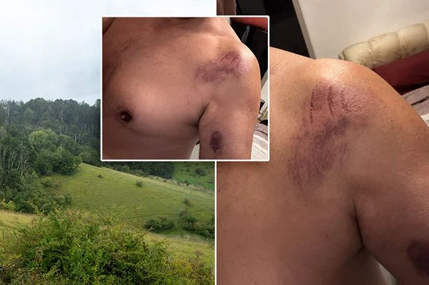 Man 'attacked by a leopard' walking in English countryside and beast left claw marks