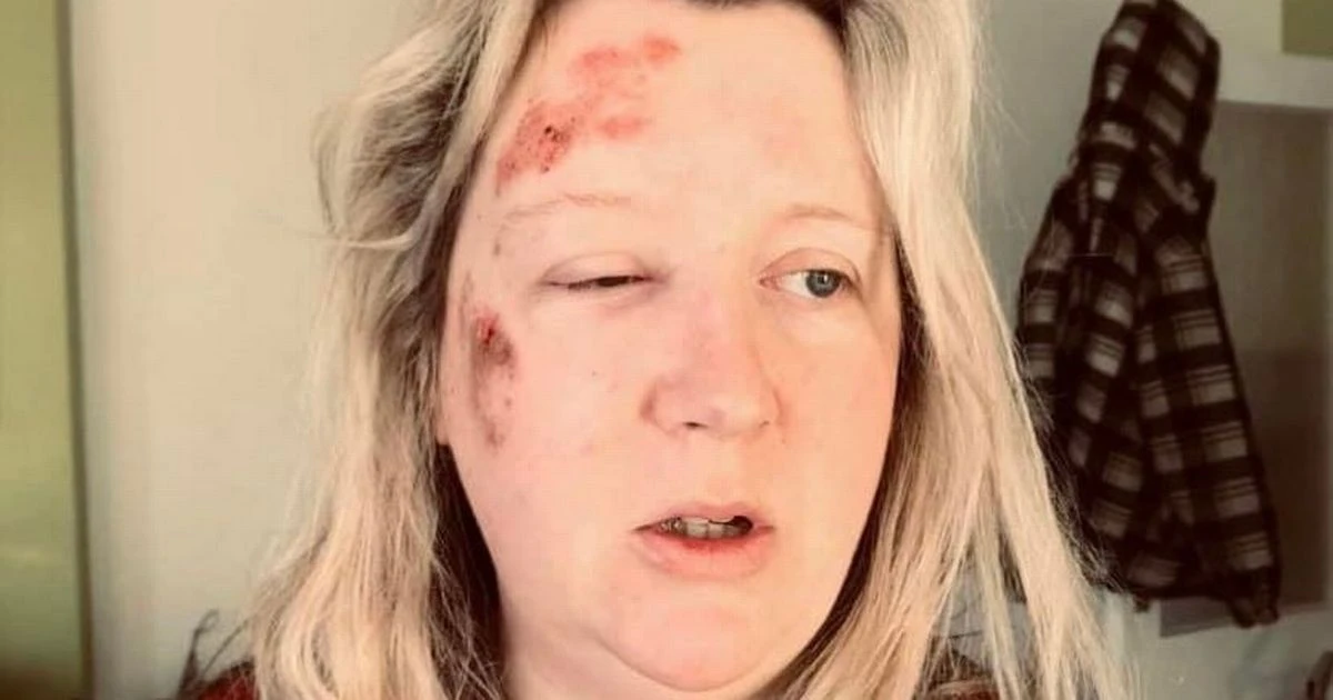 Mum's horror injuries after being set upon by teens as she returned from nursery