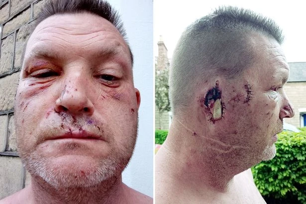 XL bully ripped off man's ear while he slept in scene from 'a horror movie'