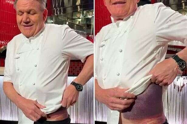 Gordon Ramsay shows off horrific injuries after he 'nearly died' in terrifying accident