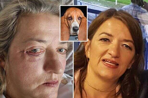 Mum flew to Turkey for birthday procedure – she returned looking like a basset hound