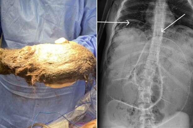 Ultra-rare syndrome see doctors remove massive hairball from teenage girl