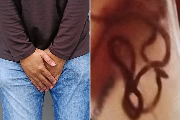 Doctors find 'giant human parasite' living inside man's bladder after cooking mistake