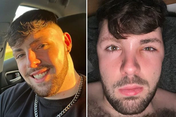 Man's head swells 'like a balloon' as he ignores 'no sex' rule after Turkey hair transplant