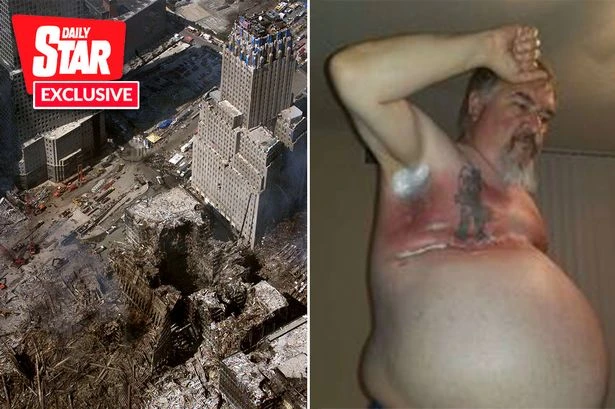 '9/11 gave me breast cancer – my body swelled like balloons and went as red as raw steak'