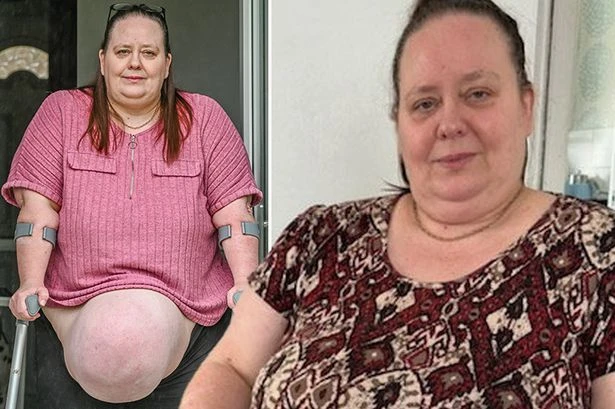 Woman with 'biggest hernia doctors ever saw' stuck living 17-year 'nightmare'