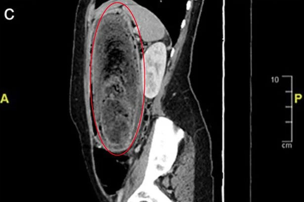 Horrified medics pull giant hairball out of 17-year-old 'Rapunzel's' stomach