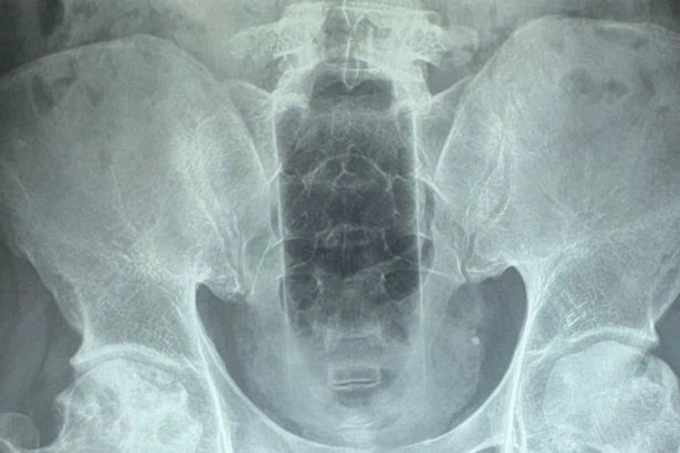 Doctors remove 20cm bottle from bloke's bum after he gets it stuck while 'cleaning himself'