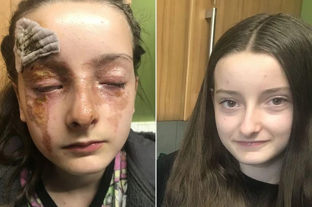 Schoolgirl, 12, suffers horror facial burns trying microwave egg 'hack' seen online